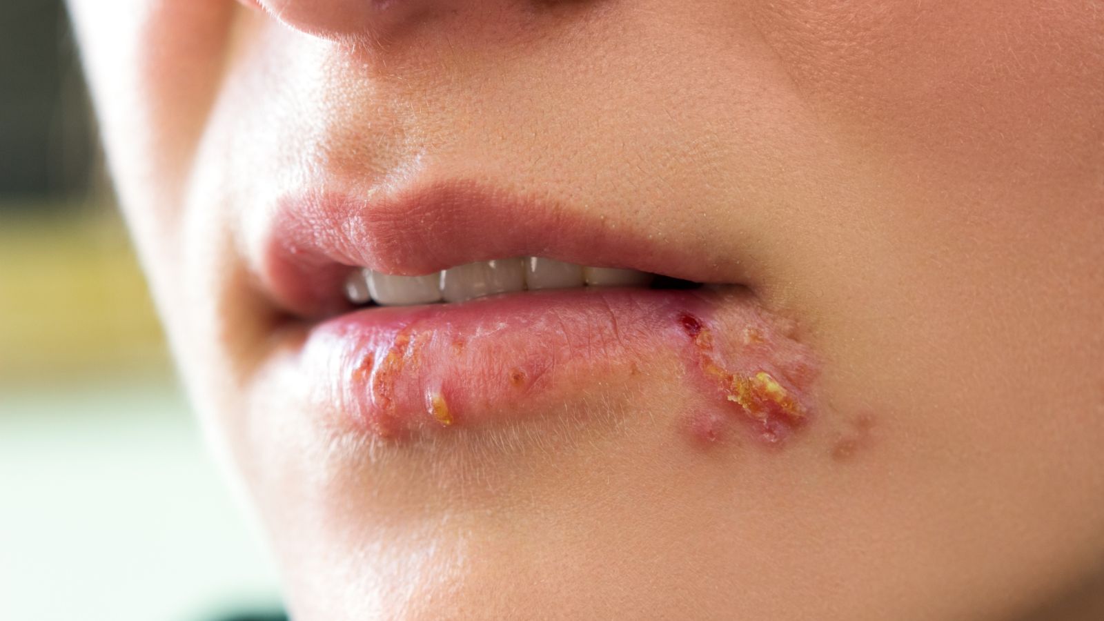 herpes simplex